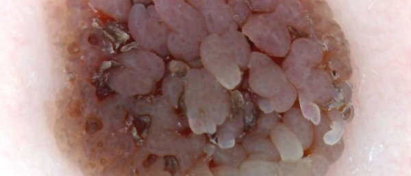 Базальноклеточные папилломы