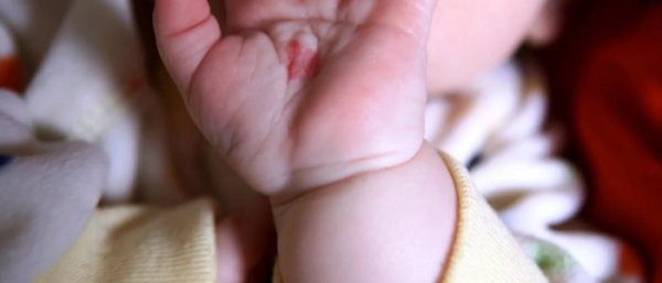 Как начинают появляться родинки у детей