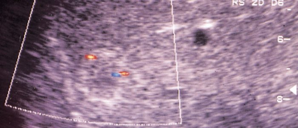 Гемангиома почек