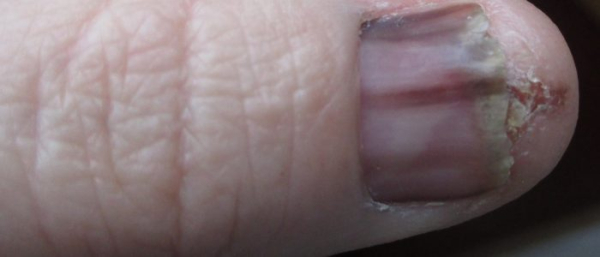 Акрально-лентигинозная меланома