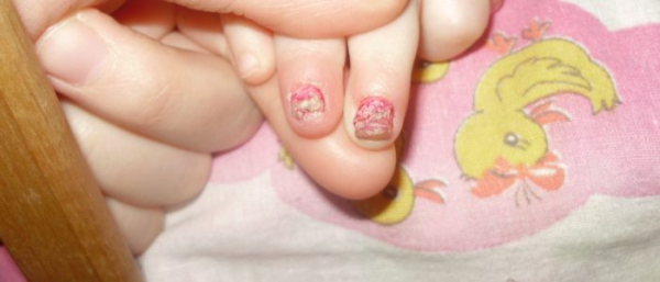 Наросты на ногтевой пластине