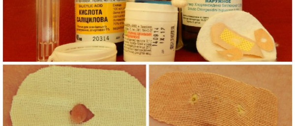 Удаление папиллом спиртом