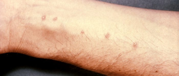 Жировики на руках