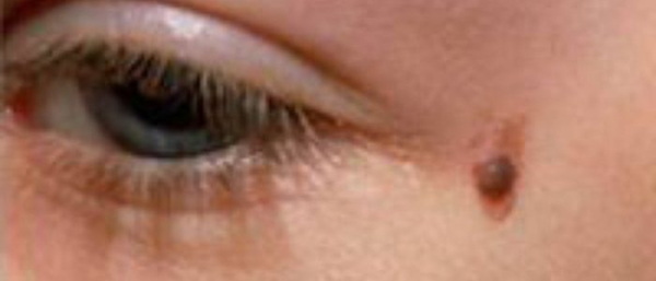 Родинки на ножке