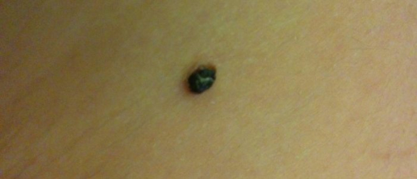 Выпуклые родинки