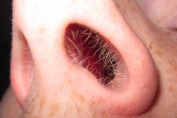 Меланома на слизистой оболочке