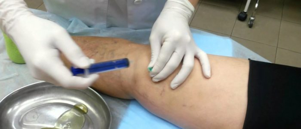 Воспаление атеромы