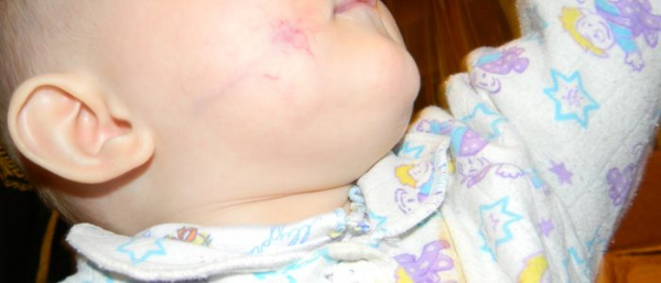 Гемангиома у ребенка