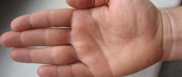 Родинки на ладонях