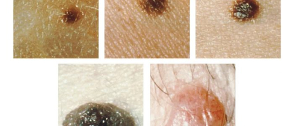 Цвет родинок на теле