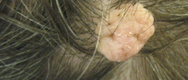 Папилломатозные невусы