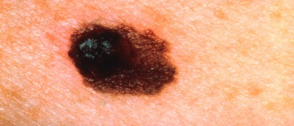 Родинки с коричневым ободком