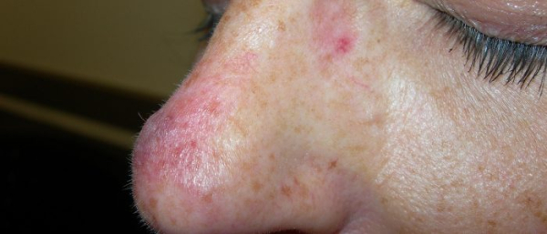 Что такое ангиома?