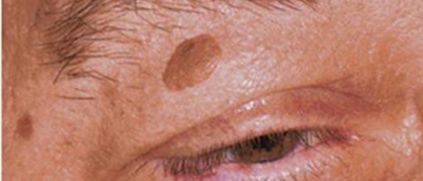 Можно ли загорать при папилломах?