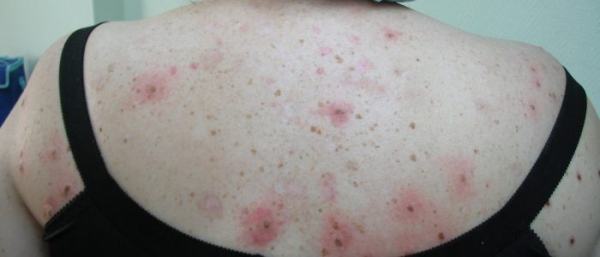 Себорейные кератомы