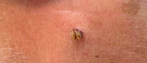 Почернение папилломы