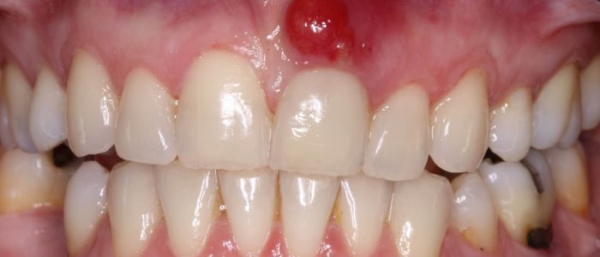 Наросты на десне