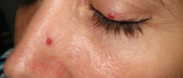 Покраснела и опухла родинка