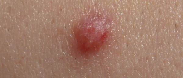 Покраснение и воспаление папилломы