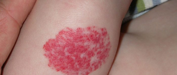 Капиллярные гемангиомы