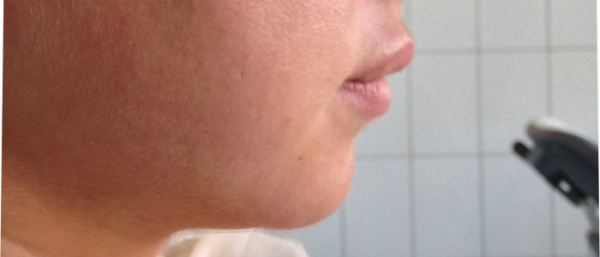 Атерома лица