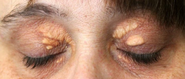 Ксантелазма век