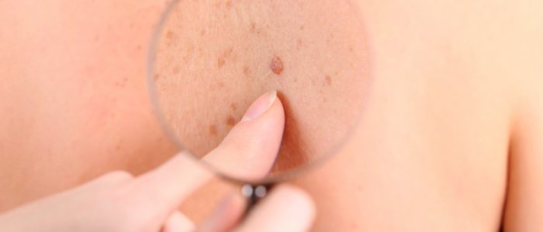 Белая родинка