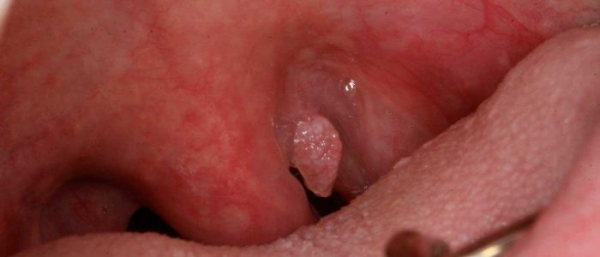 ВПЧ в горле