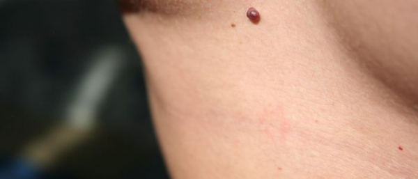 Невус при беременности