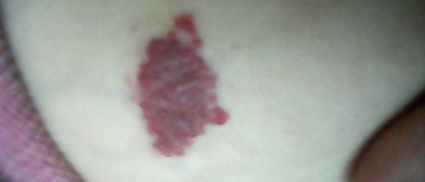 Гемангиома кровоточит