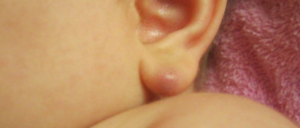 Атерома на ухе