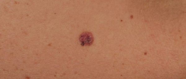 Пигментные невусы