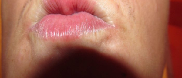 Жировики в губе