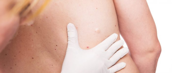 От чего может расти липома?