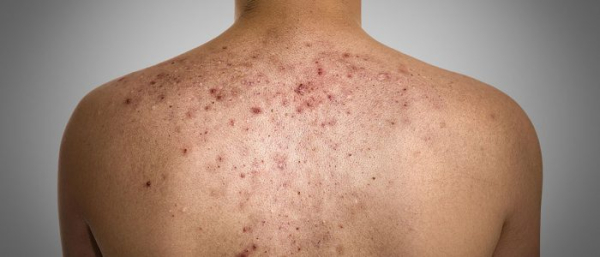 Что такое липоматоз?