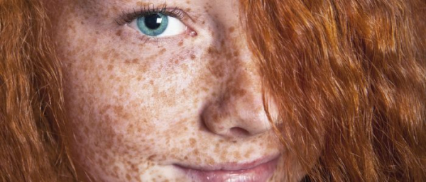 Кора от веснушек и пигментных пятен