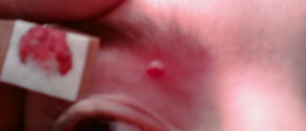 Травма папилломы