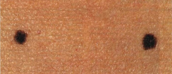 Черные родинки