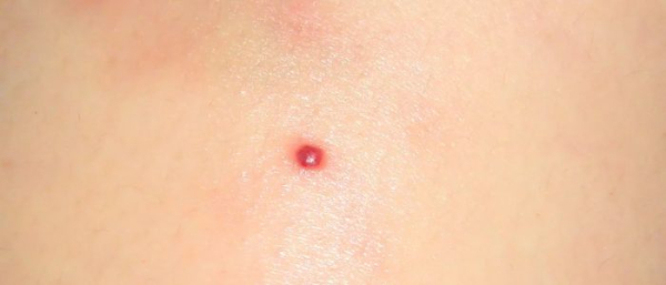 Прыщик на родинке