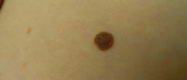 Большие родинки