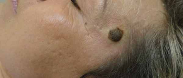 На родинке появился нарост