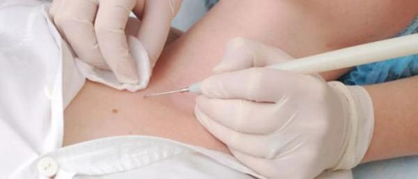 Что делать чтобы жировик прорвался?