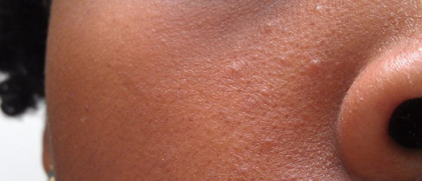 Внутренний чирей