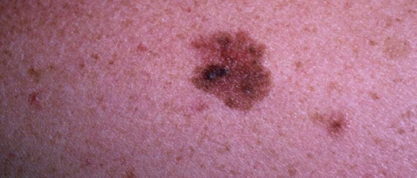 Как распознать родинку и меланому?