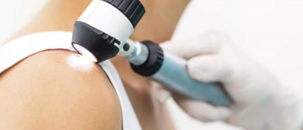 Обследование родинок