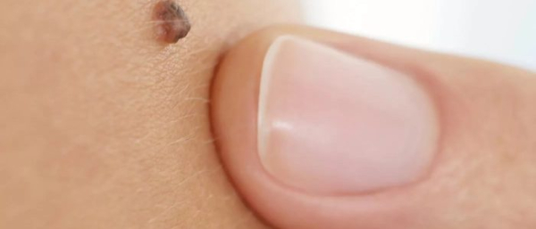 Родинка или веснушка?