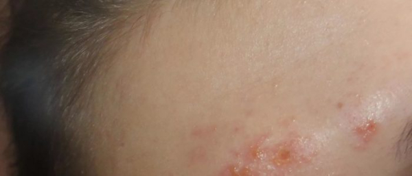 Чирей на лбу