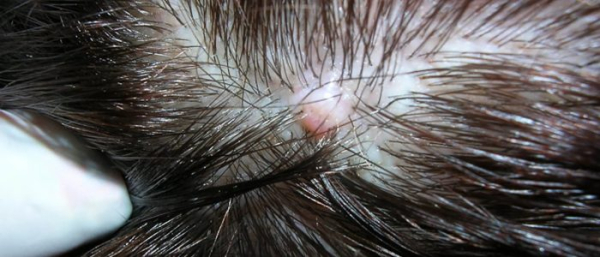 Лечение фурункула на голове