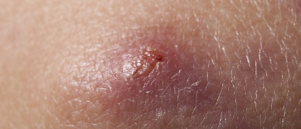 Лечение фурункулеза