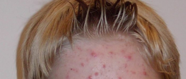 Отличие фурункула от карбункула